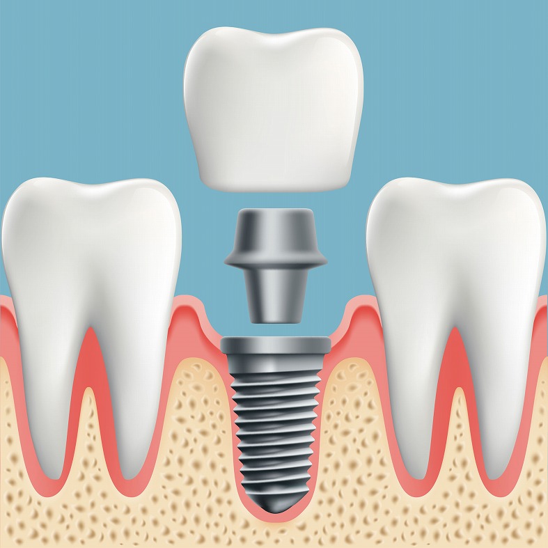 インプラント
