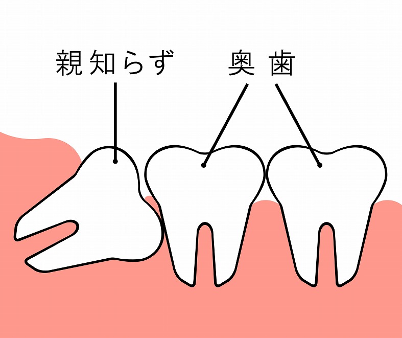 親知らずについて