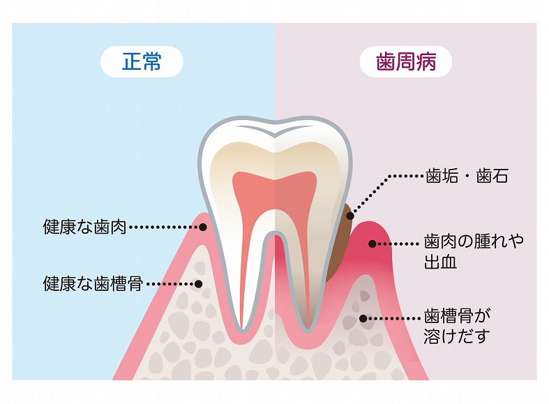 歯周病とはどんなものか？