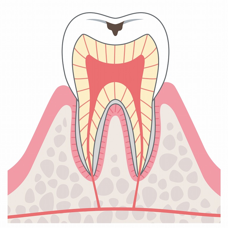 第2段階　エナメル質の虫歯（C1）