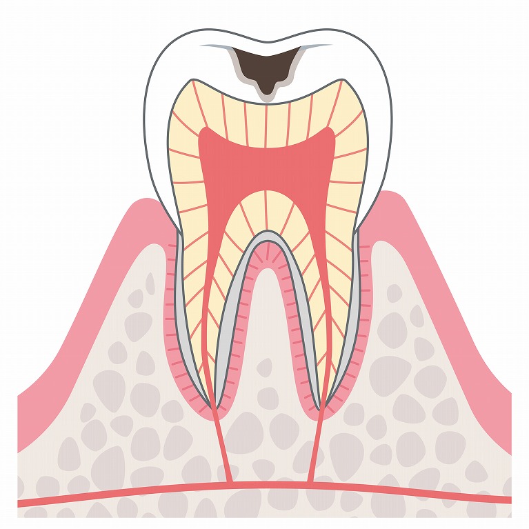 第3段階　象牙質の虫歯（C2）