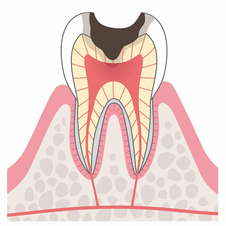 第4段階　神経（歯髄）の虫歯（C3）