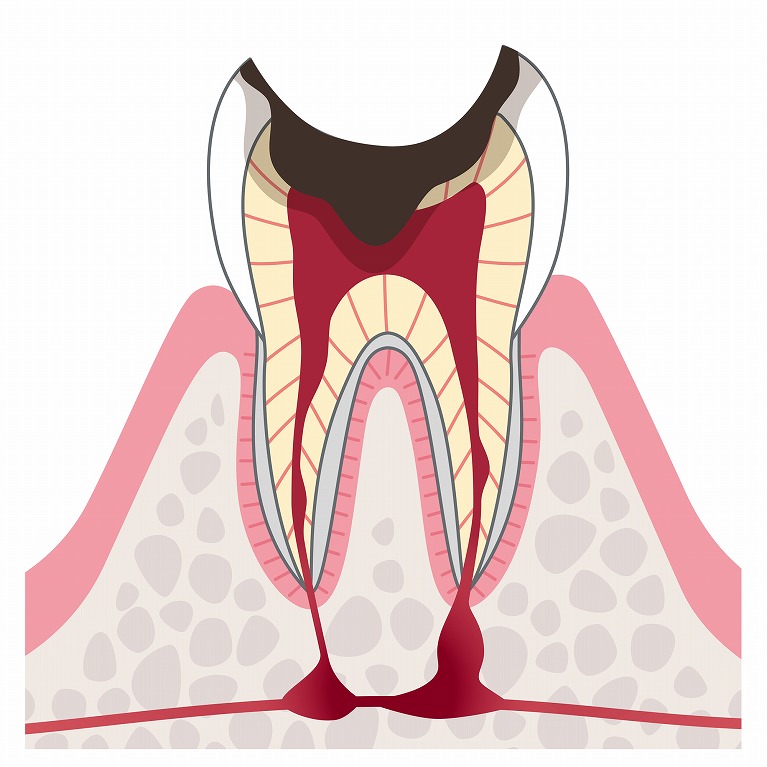 第5段階　歯根の虫歯（C4）